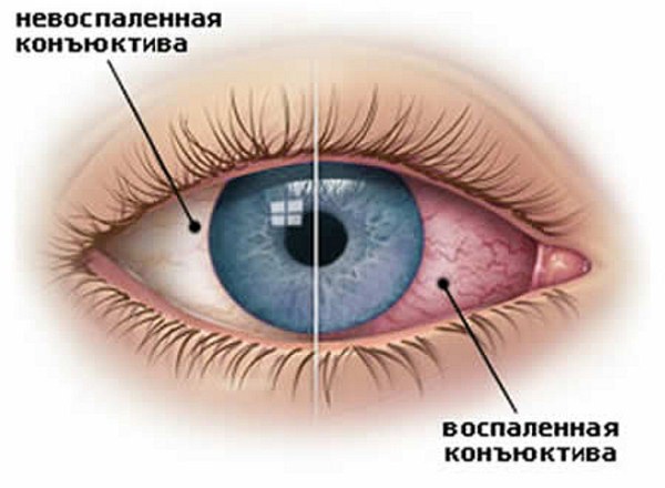 коньюктивит глаз лечение у детей